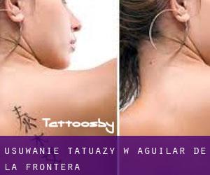 Usuwanie tatuaży w Aguilar de la Frontera