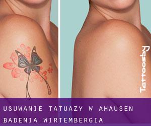Usuwanie tatuaży w Ahausen (Badenia-Wirtembergia)