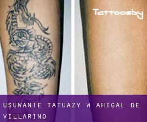 Usuwanie tatuaży w Ahigal de Villarino