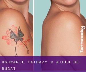 Usuwanie tatuaży w Aielo de Rugat