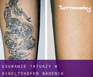 Usuwanie tatuaży w Aigeltshofen (Badenia-Wirtembergia)