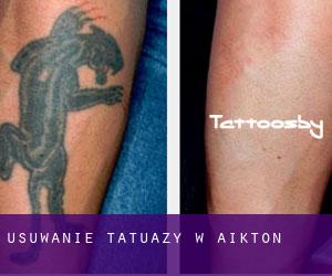 Usuwanie tatuaży w Aikton
