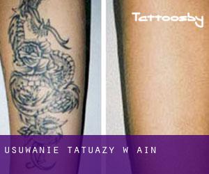 Usuwanie tatuaży w Aín