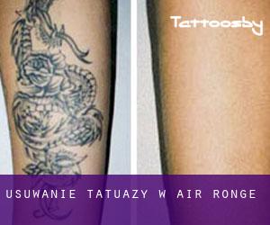 Usuwanie tatuaży w Air Ronge