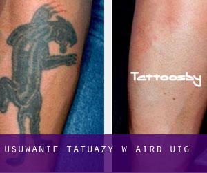 Usuwanie tatuaży w Aird Uig