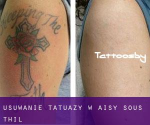 Usuwanie tatuaży w Aisy-sous-Thil