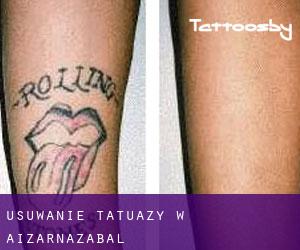 Usuwanie tatuaży w Aizarnazabal