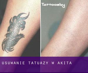 Usuwanie tatuaży w Akita
