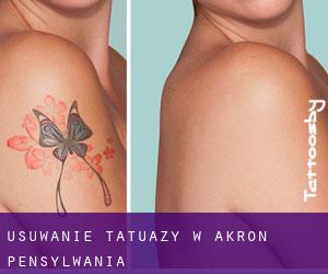 Usuwanie tatuaży w Akron (Pensylwania)
