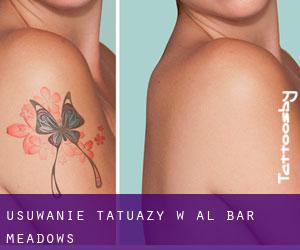 Usuwanie tatuaży w Al Bar Meadows