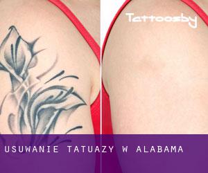 Usuwanie tatuaży w Alabama