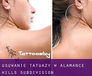 Usuwanie tatuaży w Alamance Hills Subdivision