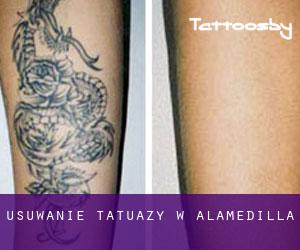 Usuwanie tatuaży w Alamedilla
