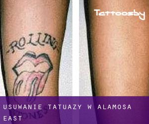 Usuwanie tatuaży w Alamosa East