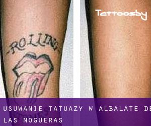Usuwanie tatuaży w Albalate de las Nogueras