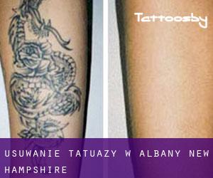 Usuwanie tatuaży w Albany (New Hampshire)