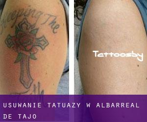 Usuwanie tatuaży w Albarreal de Tajo