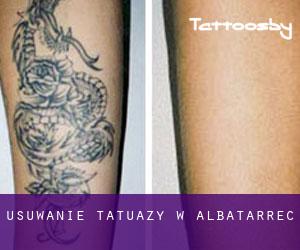 Usuwanie tatuaży w Albatàrrec