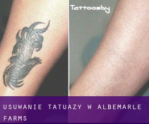 Usuwanie tatuaży w Albemarle Farms
