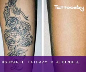 Usuwanie tatuaży w Albendea
