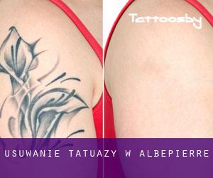 Usuwanie tatuaży w Albepierre