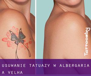 Usuwanie tatuaży w Albergaria-A-Velha