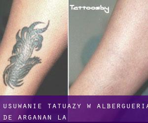 Usuwanie tatuaży w Alberguería de Argañán (La)