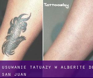 Usuwanie tatuaży w Alberite de San Juan