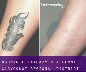 Usuwanie tatuaży w Alberni-Clayoquot Regional District