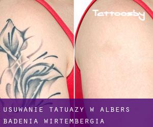 Usuwanie tatuaży w Albers (Badenia-Wirtembergia)
