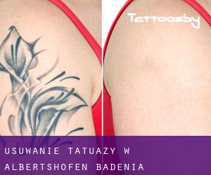 Usuwanie tatuaży w Albertshofen (Badenia-Wirtembergia)