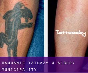 Usuwanie tatuaży w Albury Municipality