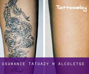 Usuwanie tatuaży w Alcoletge