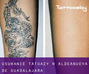 Usuwanie tatuaży w Aldeanueva de Guadalajara