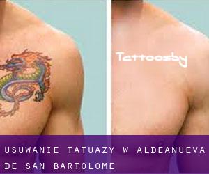 Usuwanie tatuaży w Aldeanueva de San Bartolomé