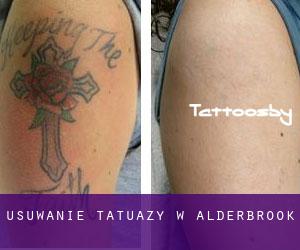 Usuwanie tatuaży w Alderbrook