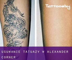 Usuwanie tatuaży w Alexander Corner