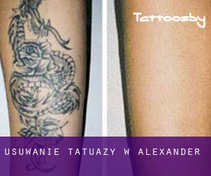 Usuwanie tatuaży w Alexander