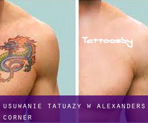 Usuwanie tatuaży w Alexanders Corner