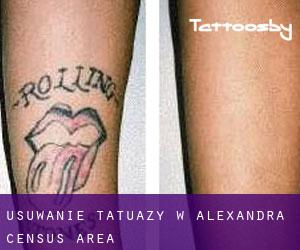 Usuwanie tatuaży w Alexandra (census area)