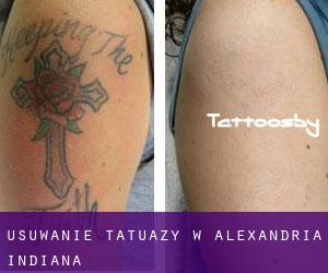 Usuwanie tatuaży w Alexandria (Indiana)