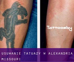 Usuwanie tatuaży w Alexandria (Missouri)