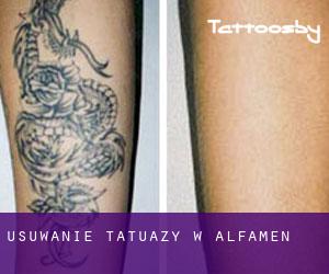 Usuwanie tatuaży w Alfamén