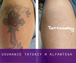 Usuwanie tatuaży w Alfántega