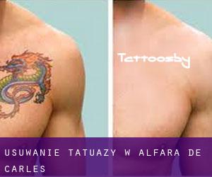 Usuwanie tatuaży w Alfara de Carles