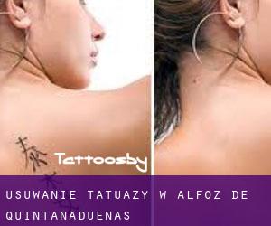 Usuwanie tatuaży w Alfoz de Quintanadueñas