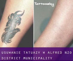 Usuwanie tatuaży w Alfred Nzo District Municipality