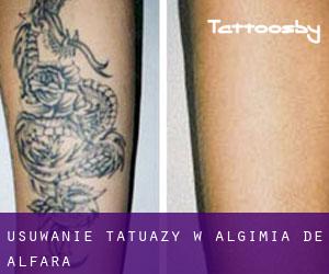 Usuwanie tatuaży w Algimia de Alfara