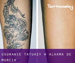 Usuwanie tatuaży w Alhama de Murcia