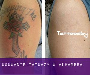 Usuwanie tatuaży w Alhambra